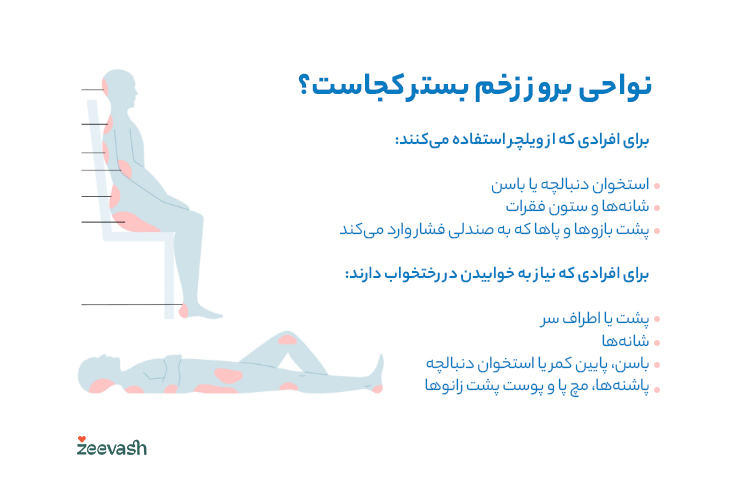 نواحی بروز زخم بستر کجاست؟